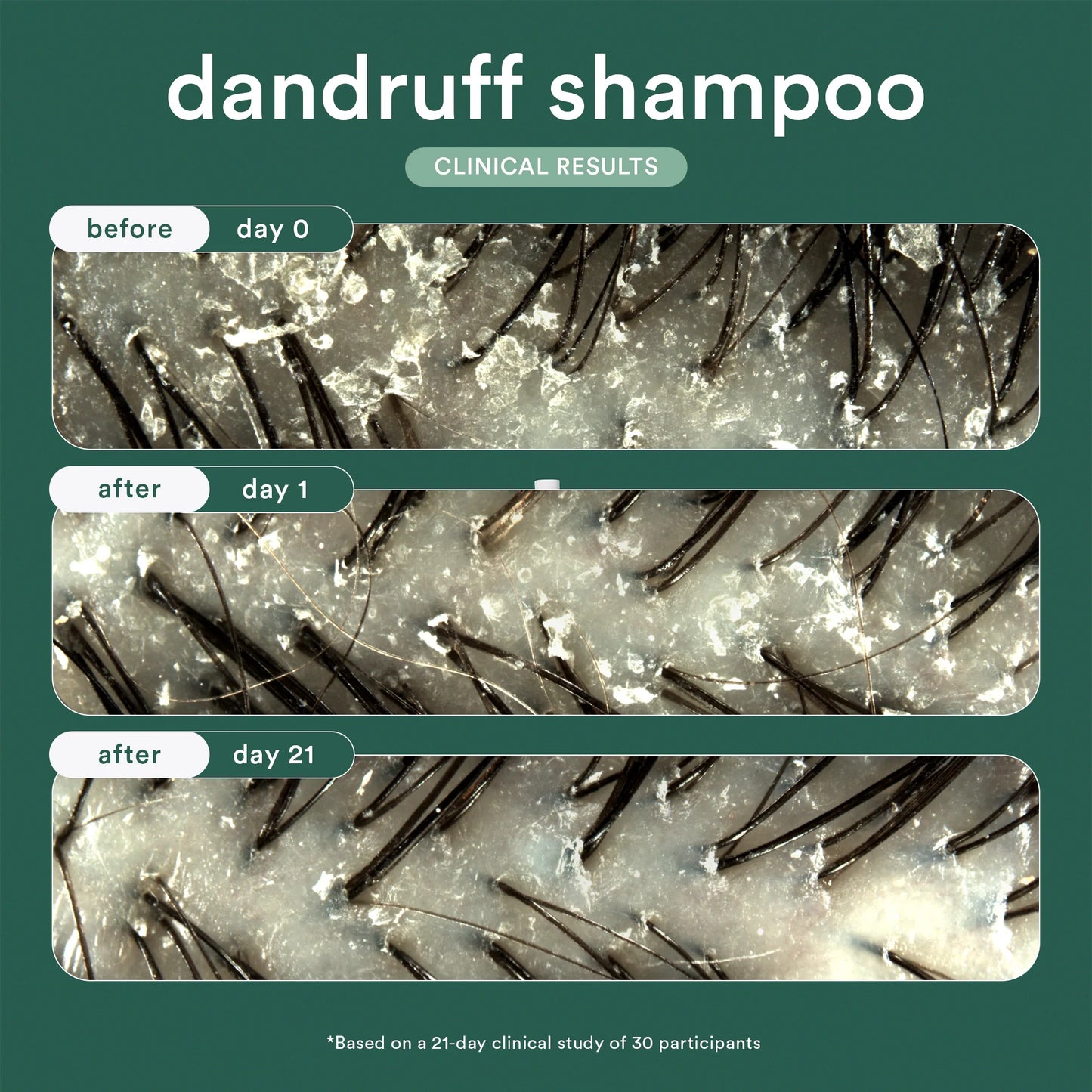 Dandruff Shampoo