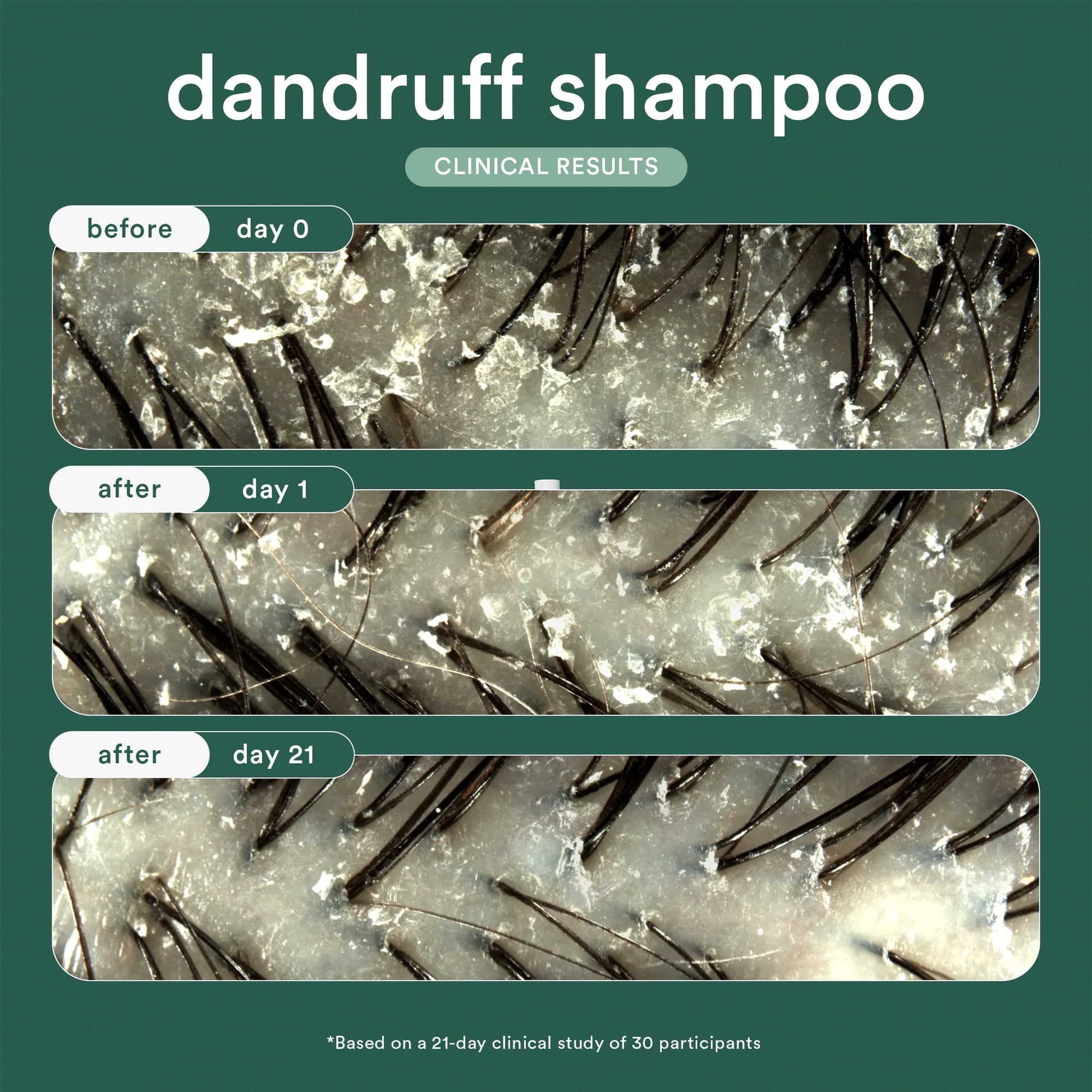 Dandruff Shampoo
